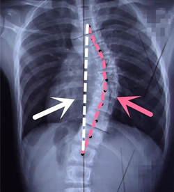 脊柱側(cè)彎后身高會變短嗎？