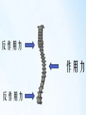 什么是脊柱側(cè)彎矯形器？