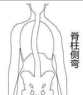 脊柱側(cè)彎康復(fù)訓(xùn)練主要從四個方面入手！