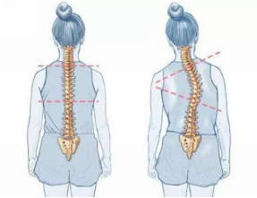 怕耽誤學習，脊柱側彎就不治療了嗎？